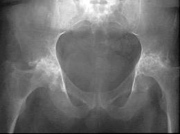 Поражение тазобедренных суставов при ревматоидном артрите