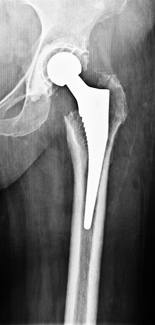 Цементный эндопротез. Тазобедренный эндопротез Райт. Подвывих эндопротеза тазобедренного. Вывих эндопротеза тазобедренного сустава рентген. Эндопротез тазобедренного сустава Моники.